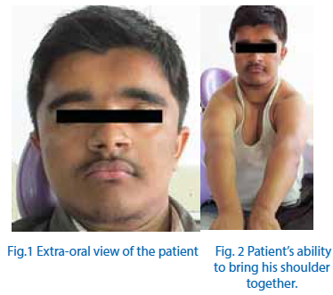 A): bell-shaped chest of the patient with cleidocranial dysplasia