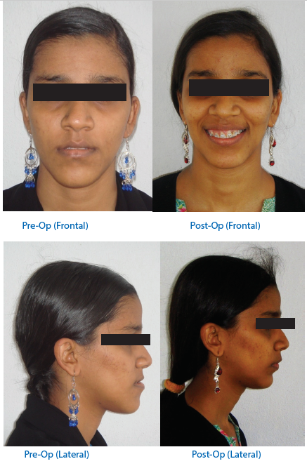 Habsburg jaw: mandibular prognathism