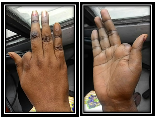 Finger prosthesis for amputee
