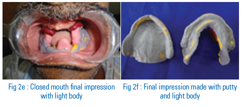 A PLETHORA OF IMPRESSION TECHNIQUES IN DIFFERENT CLINICAL