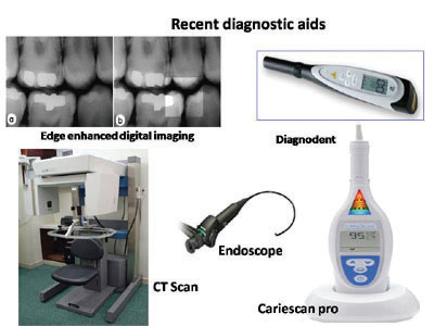 NEW UNUSED store CarieScan Pro Dental Caries Detector Diagnostic Cavity Detection Aid