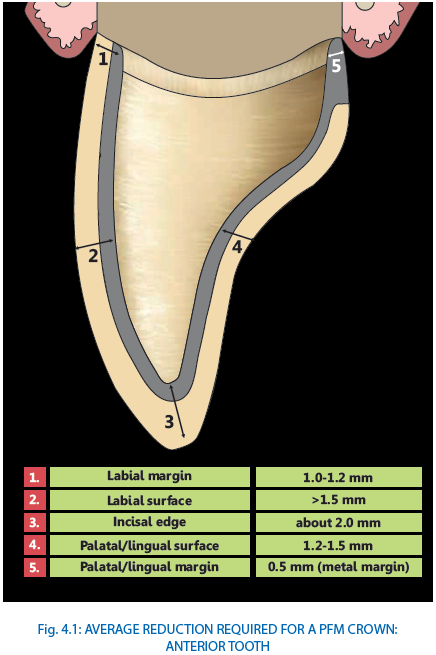 Pfm Crown Preparation PRINCIPLES OF TOOTH PREPARATION PART 7
