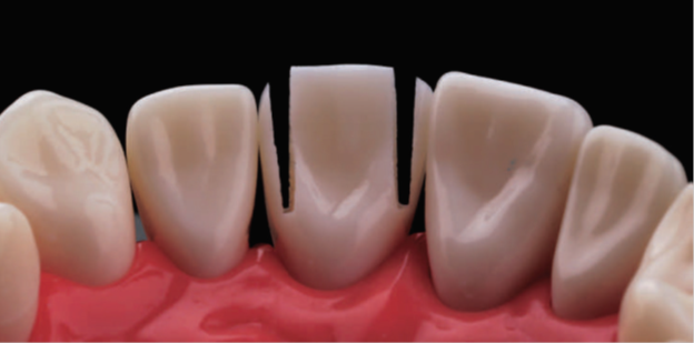 PRINCIPLES OF TOOTH PREPARATION: PART-6