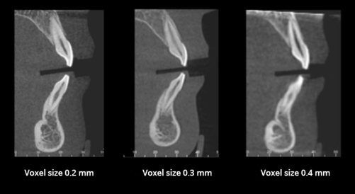 Cbct Resolution Guident : OPEN ACCESS DENTAL JOURNAL