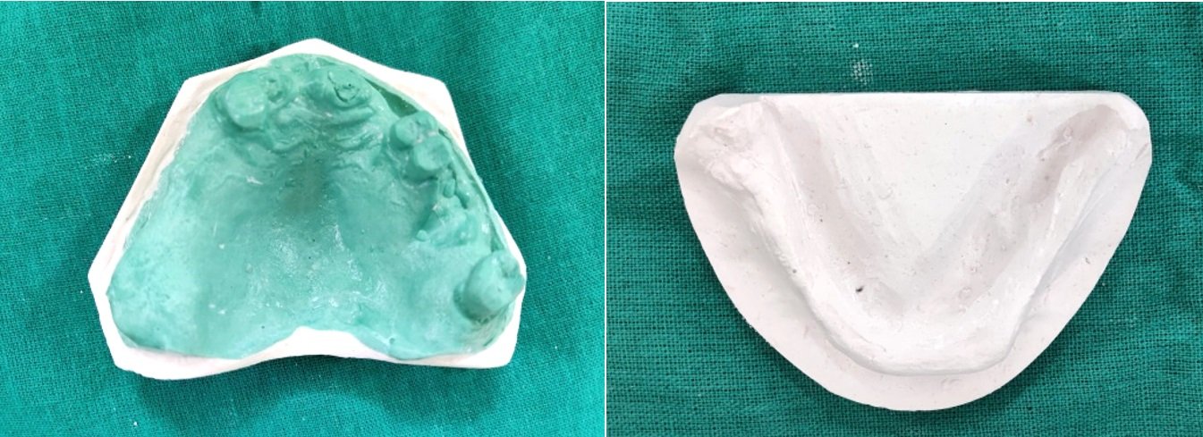 Bolt Attachment changes Partial Denture Prosthodontics - Suginaka “Riegel Best Precision Attachments in China | Robust Dental