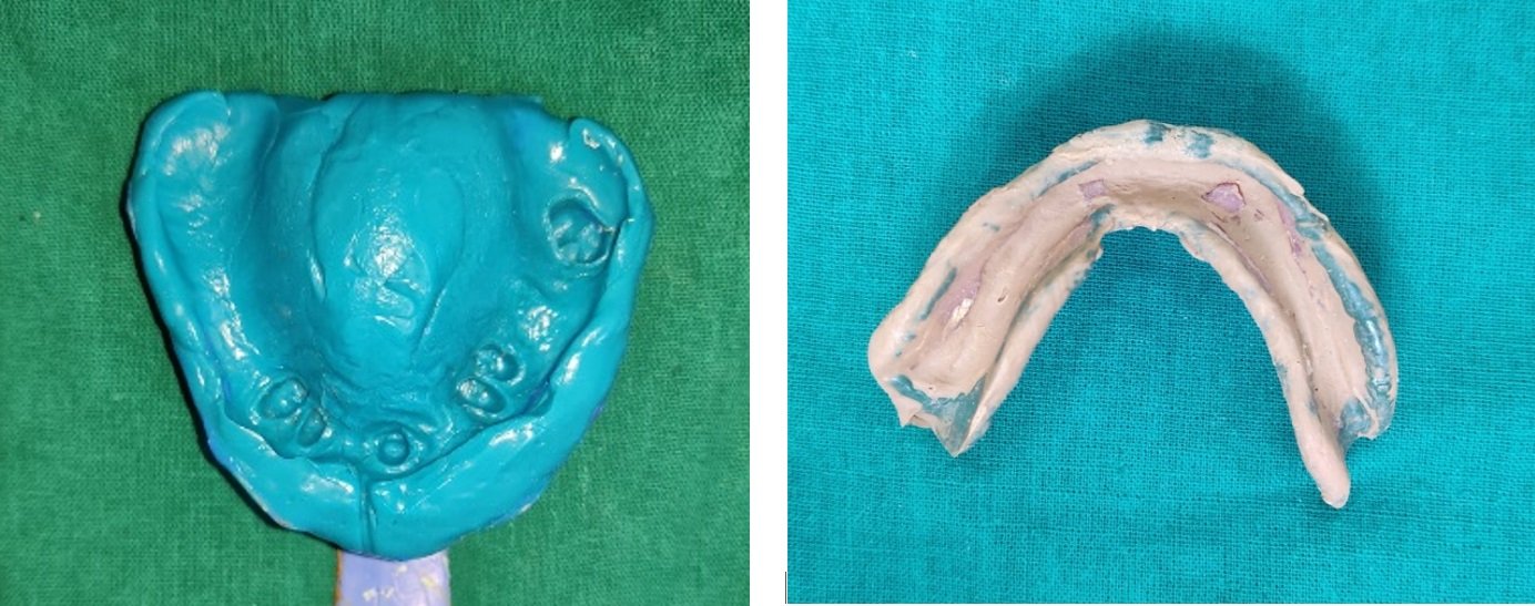 CAST PARTIAL DENTURE WITH SEMI PRECISION SAGGIX EXTRA-CORONAL