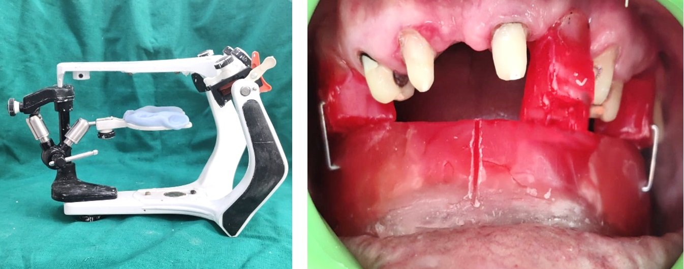 CAST PARTIAL DENTURE WITH SEMI PRECISION SAGGIX EXTRA-CORONAL