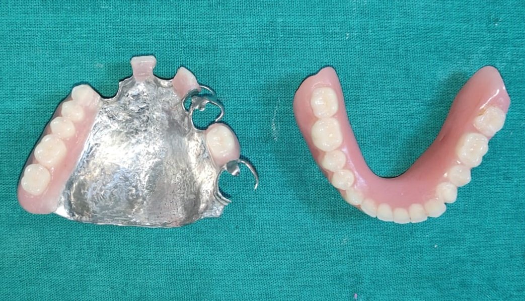 Bolt Attachment changes Partial Denture Prosthodontics - Suginaka “Riegel Bolt Attachment changes Partial Denture Prosthodontics - Suginaka