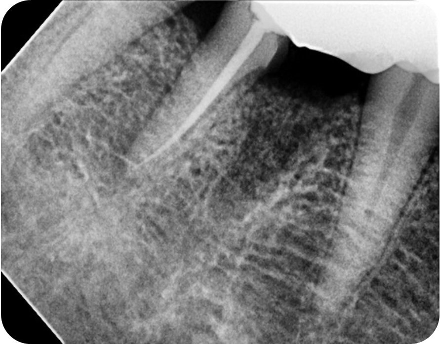 Tooth Hemisection Guident : OPEN ACCESS DENTAL JOURNAL